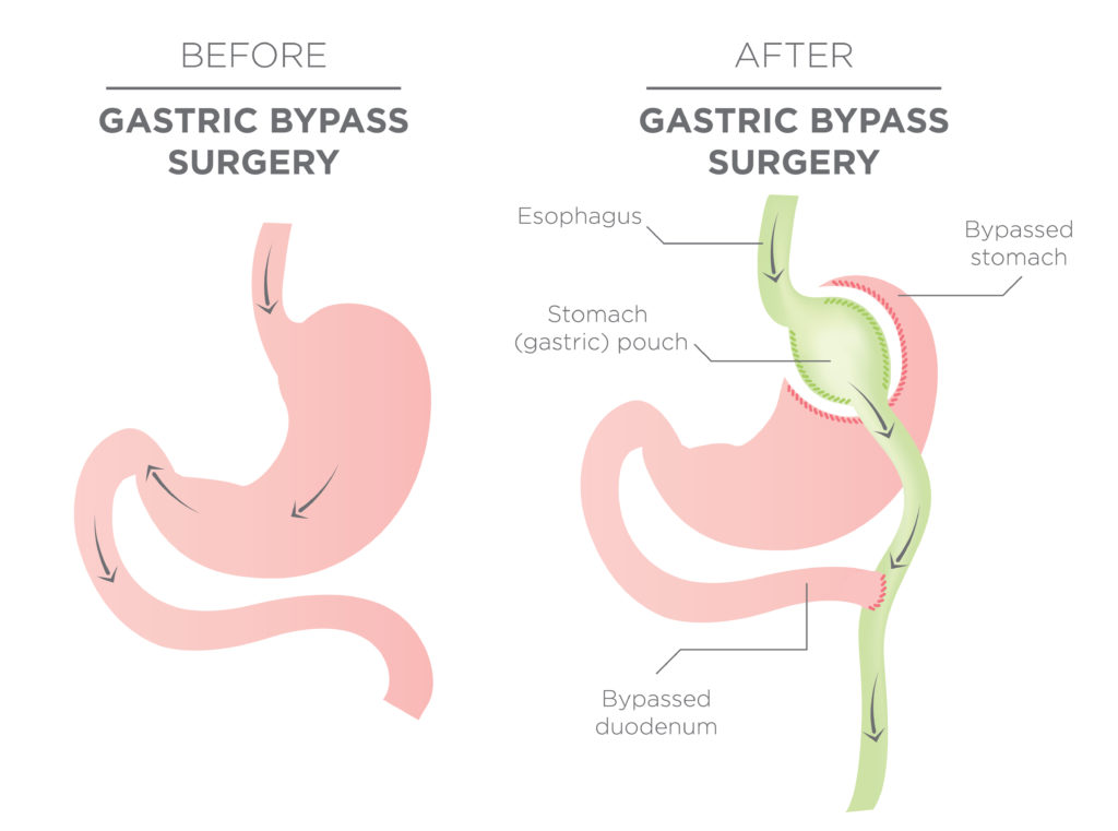 Drinking Alcohol After Bariatric Surgery Bari Life