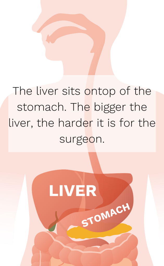 How to shrink your liver before bariatric surgery Bari Life
