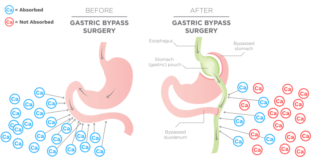 Why Do I Need Calcium After Bariatric Surgery Bari Life