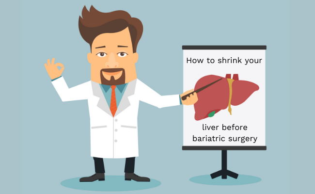 How to shrink your liver before bariatric surgery Bari Life