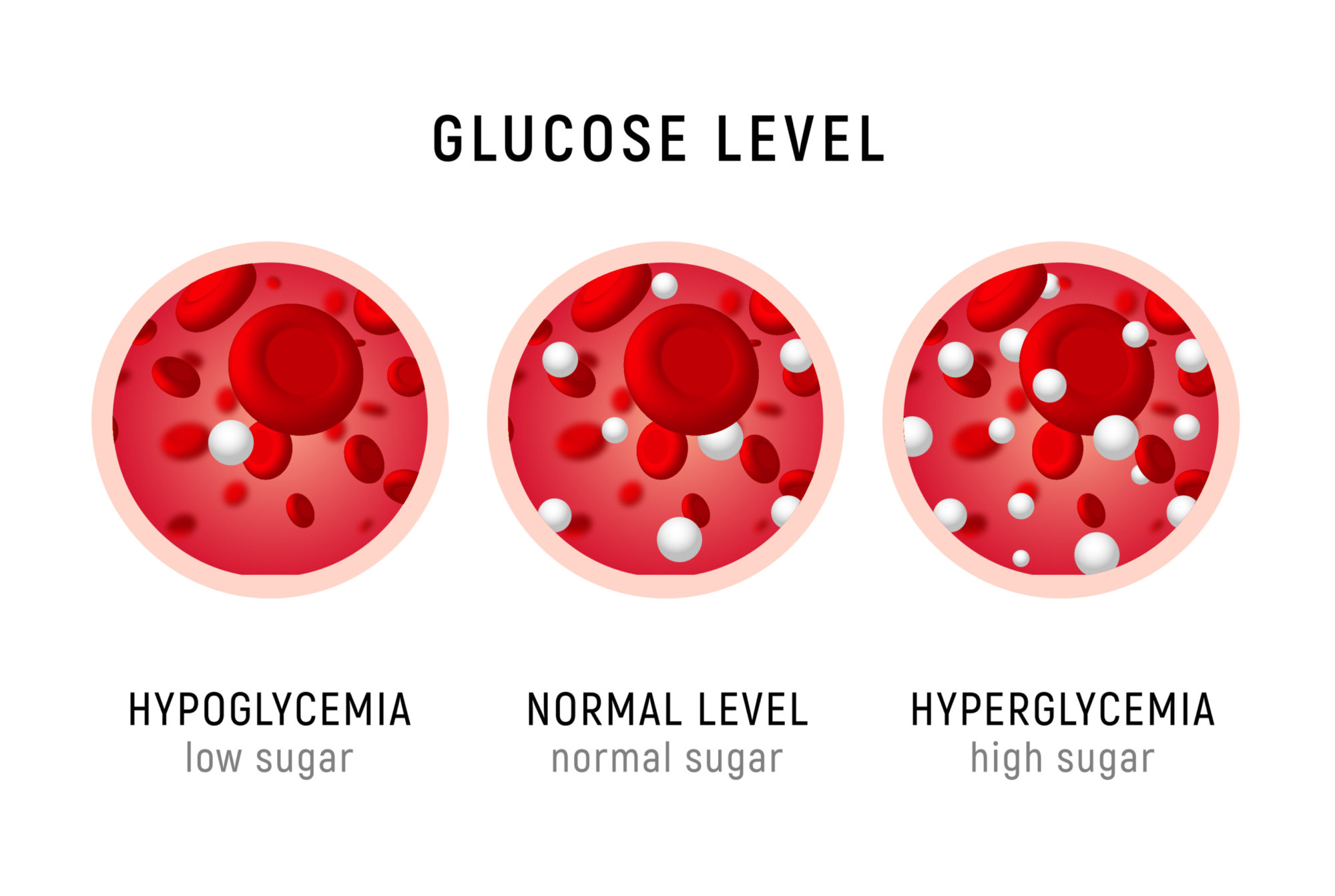 Hiperglucemia síntomas Hiperglucemia síntomas