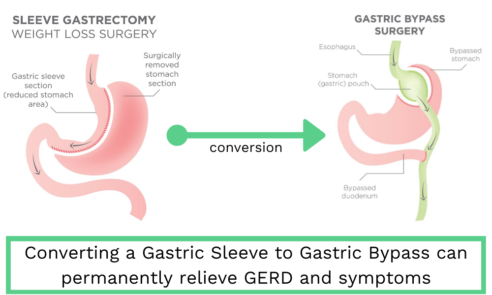 Converting from a Gastric Sleeve to Gastric Bypass can permanently relieve GERD and symptoms