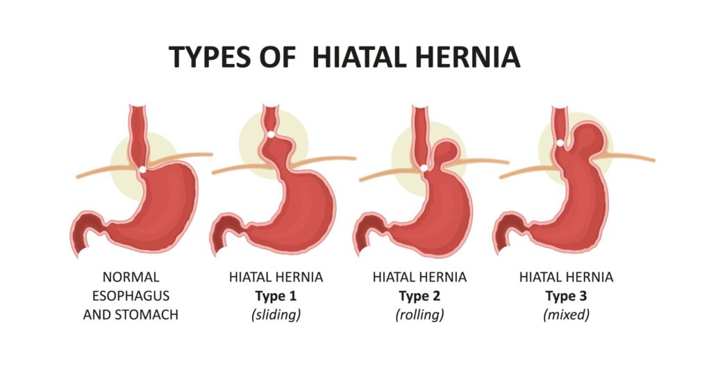 types of hiatal hernias
