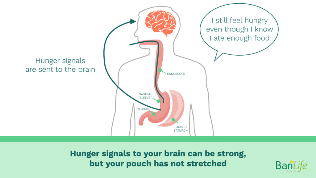 Hunger signals being sent to your brain even though there is enough food in the sleeve gastrectomy stomach