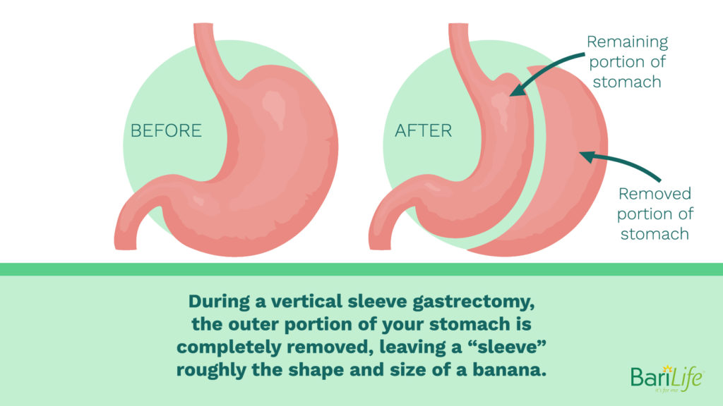 Can Liquids Stretch Your Sleeve? Bari Life