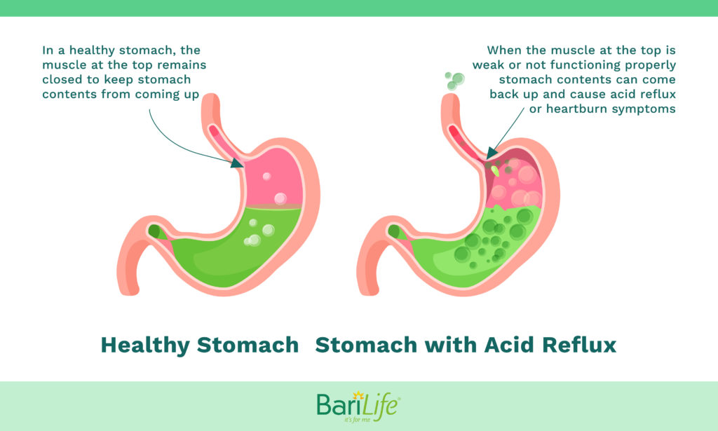 un stomac normal fără reflux acid și un stomac cu reflux acid