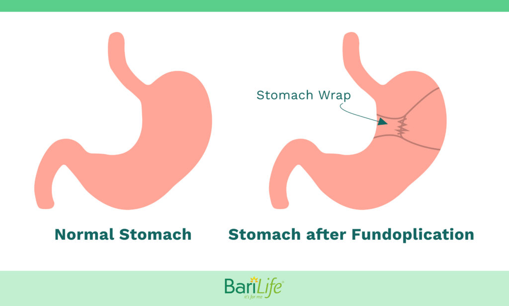 Fundoplication surgery to alleviate GERD after gastric sleeve surgery