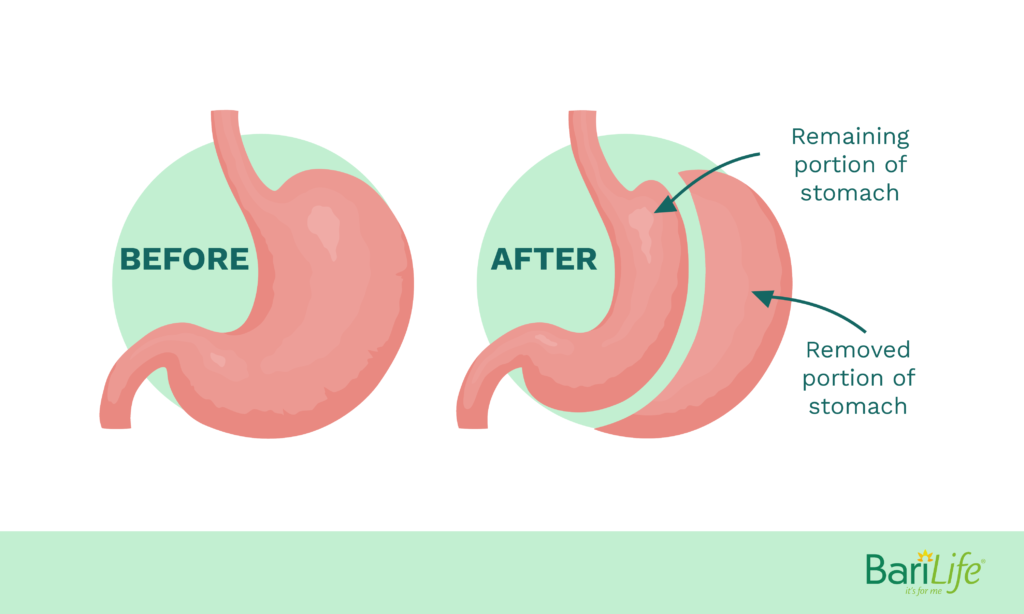 Eating One Week After Gastric Sleeve Bari Life