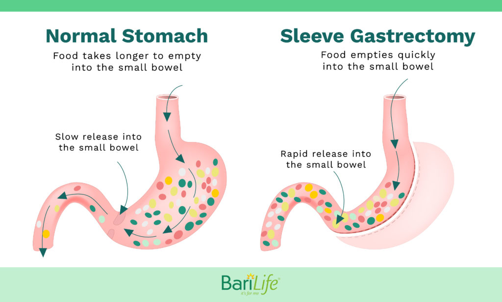 Dumping Syndrome