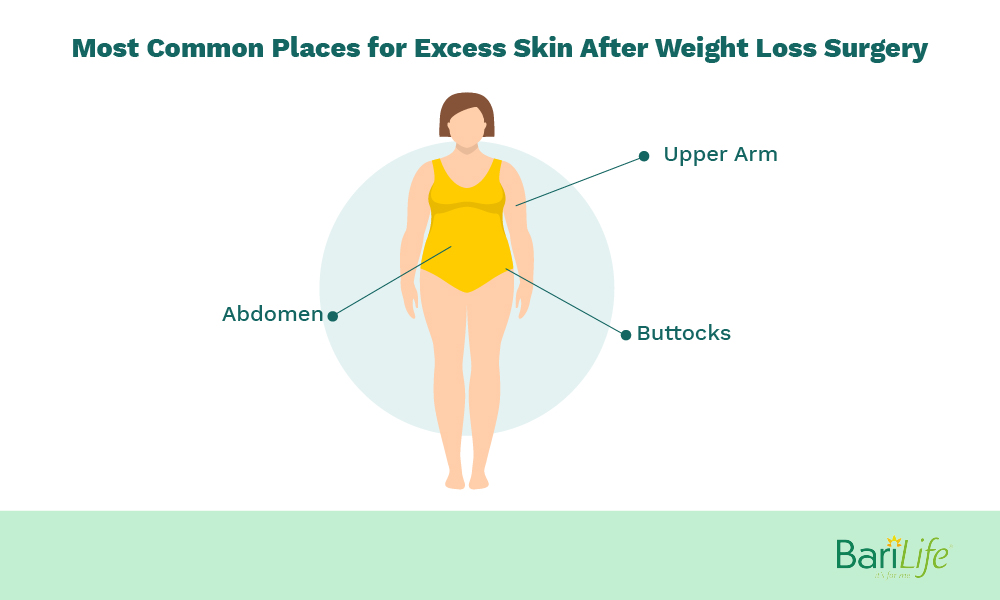 Areas where there isexcess skin post bariatric surgery