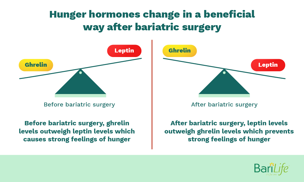 Pros and cons of gastric sleeve are beneficial hormonal changes