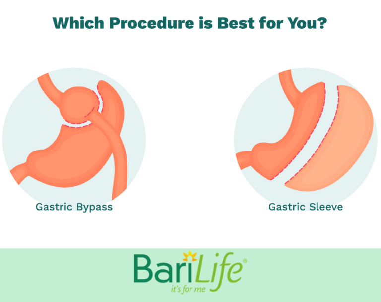 Gastric Sleeve vs Gastric Bypass: What’s Best for You?