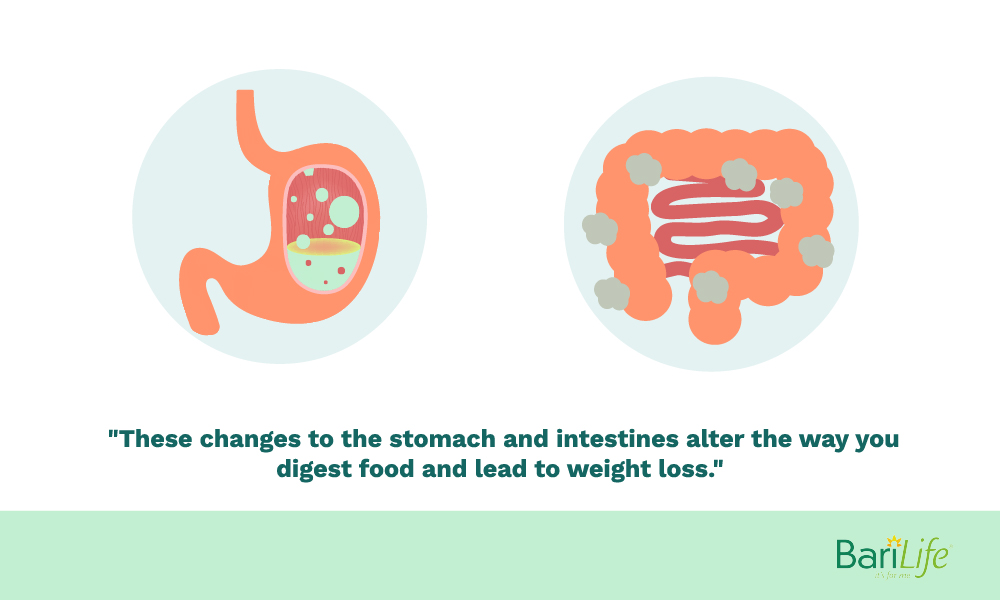 Changes to the stomach after gastric bypass surgery
