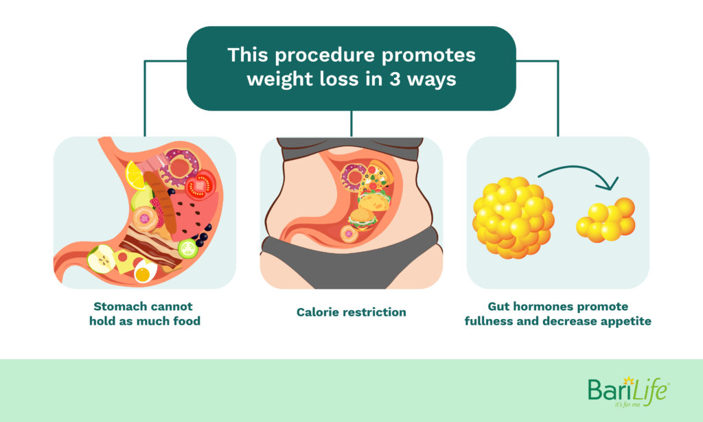 How gastric bypass causes weight loss