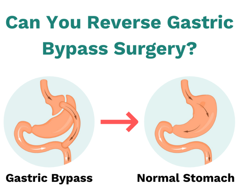 Gastric Bypass Reversal