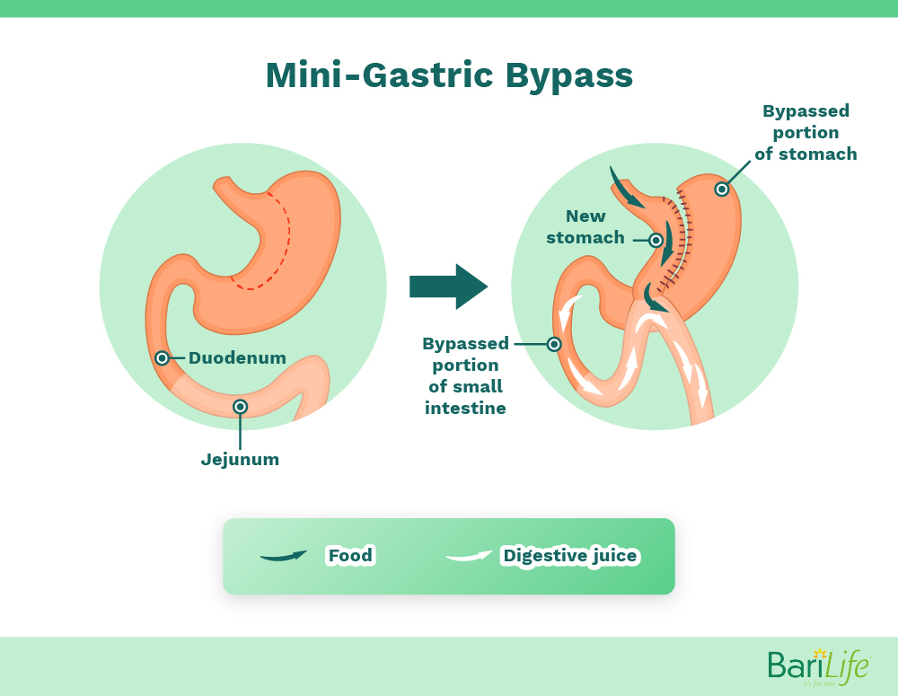 Mini gastric bypass anatomy before and after