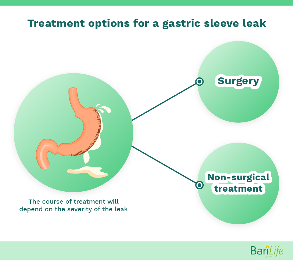 Leakage after gastric sleeve Bari Life