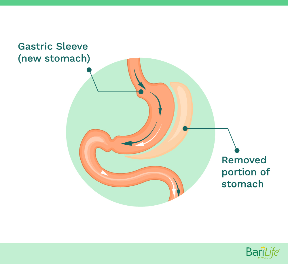 Medications to Avoid After Gastric Sleeve Surgery Bari Life