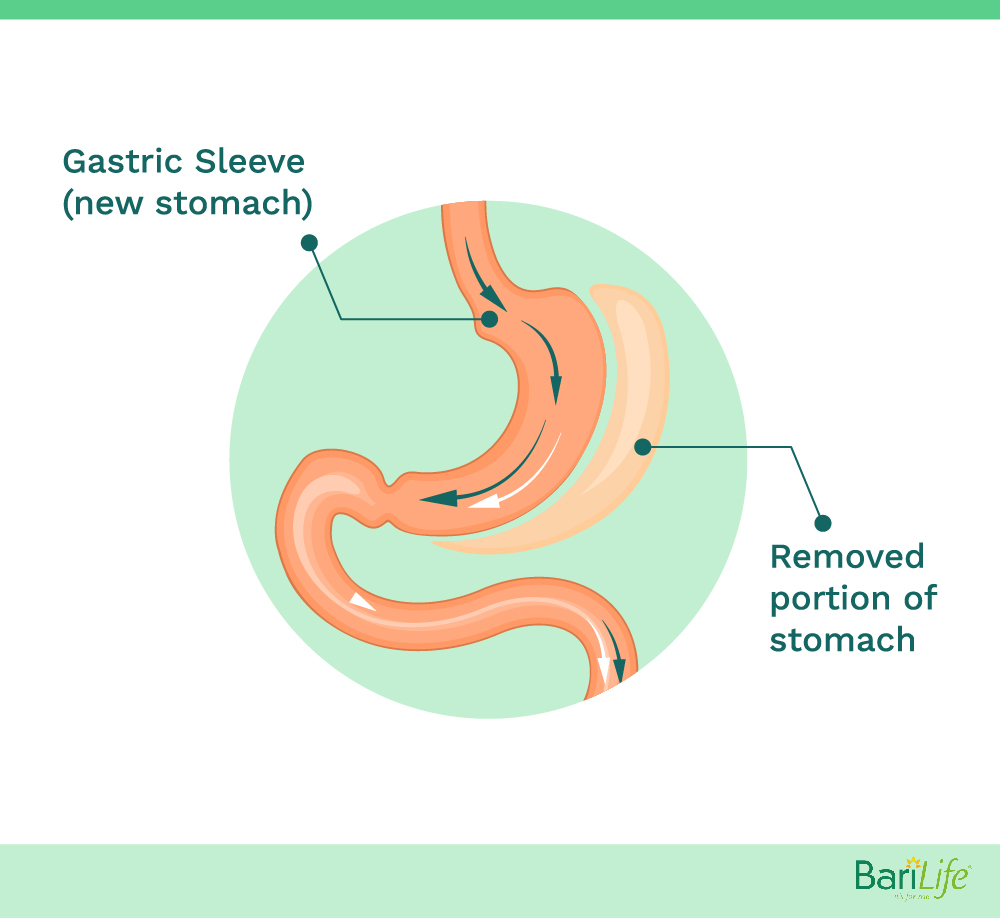 New stomach size vs old stomach side after gastric sleeve