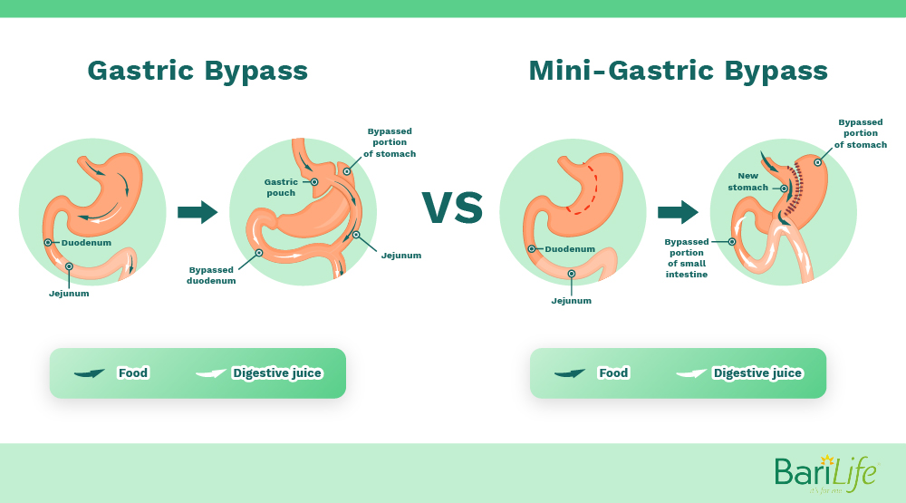 Mini Gastric Bypass Vs Rny Gastric Bypass What S The Difference