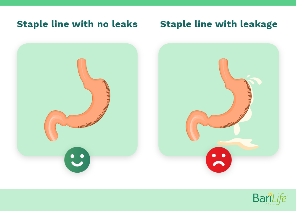 Gastrice sleeve staple line with leaks vs no leaks