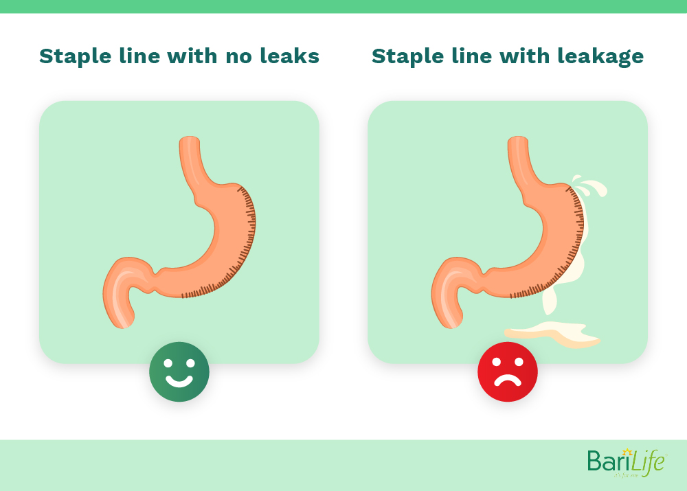 Leakage after gastric sleeve Bari Life