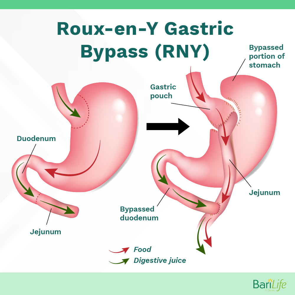 Gastric Bypass anatomy