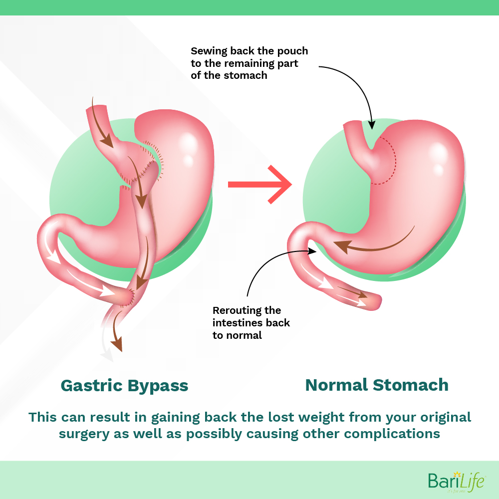 Can you have gastric sleeve after gastric bypass? Bariatric Surgery Explained Bari Life