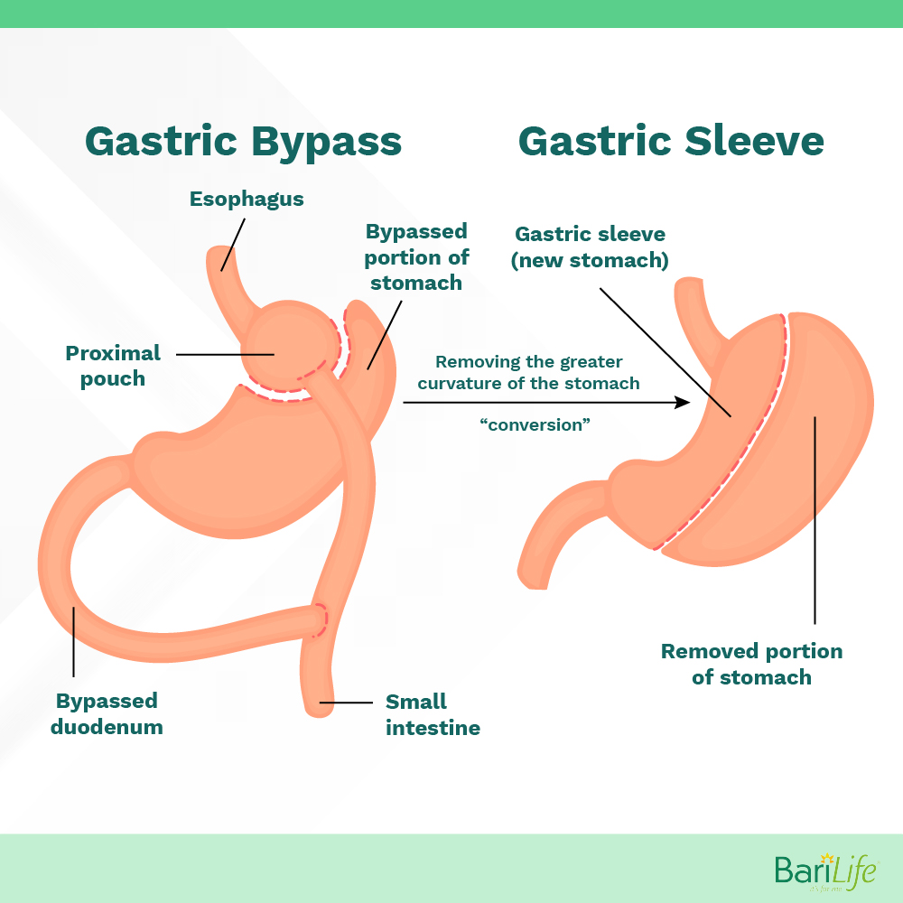 Can you have gastric sleeve after gastric bypass? Bariatric Surgery Explained Bari Life