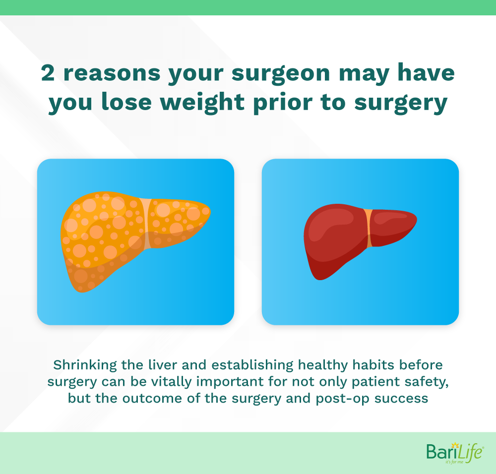 How Much Do You Have to Weigh To Have Gastric Bypass Surgery Bari Life