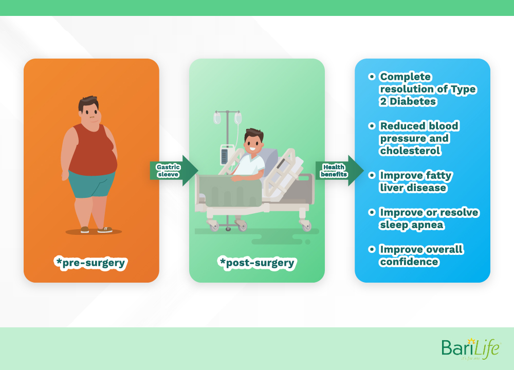 Getting the Most Out of Your Gastric Sleeve Results Bari Life