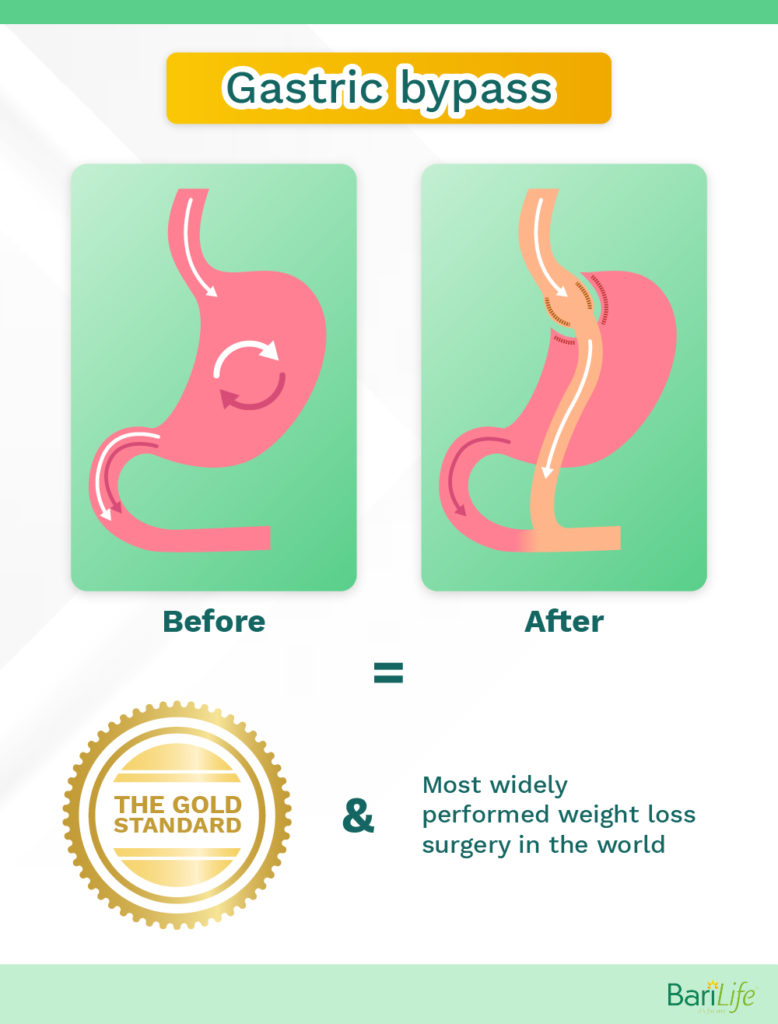 Weight loss after gastric bypass stopped? Here's how to lose the regain. Bari Life