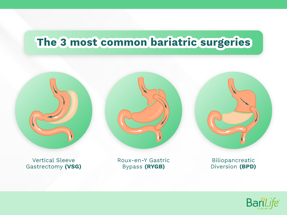 What is the Safest Form of Weight Loss Surgery? Bari Life