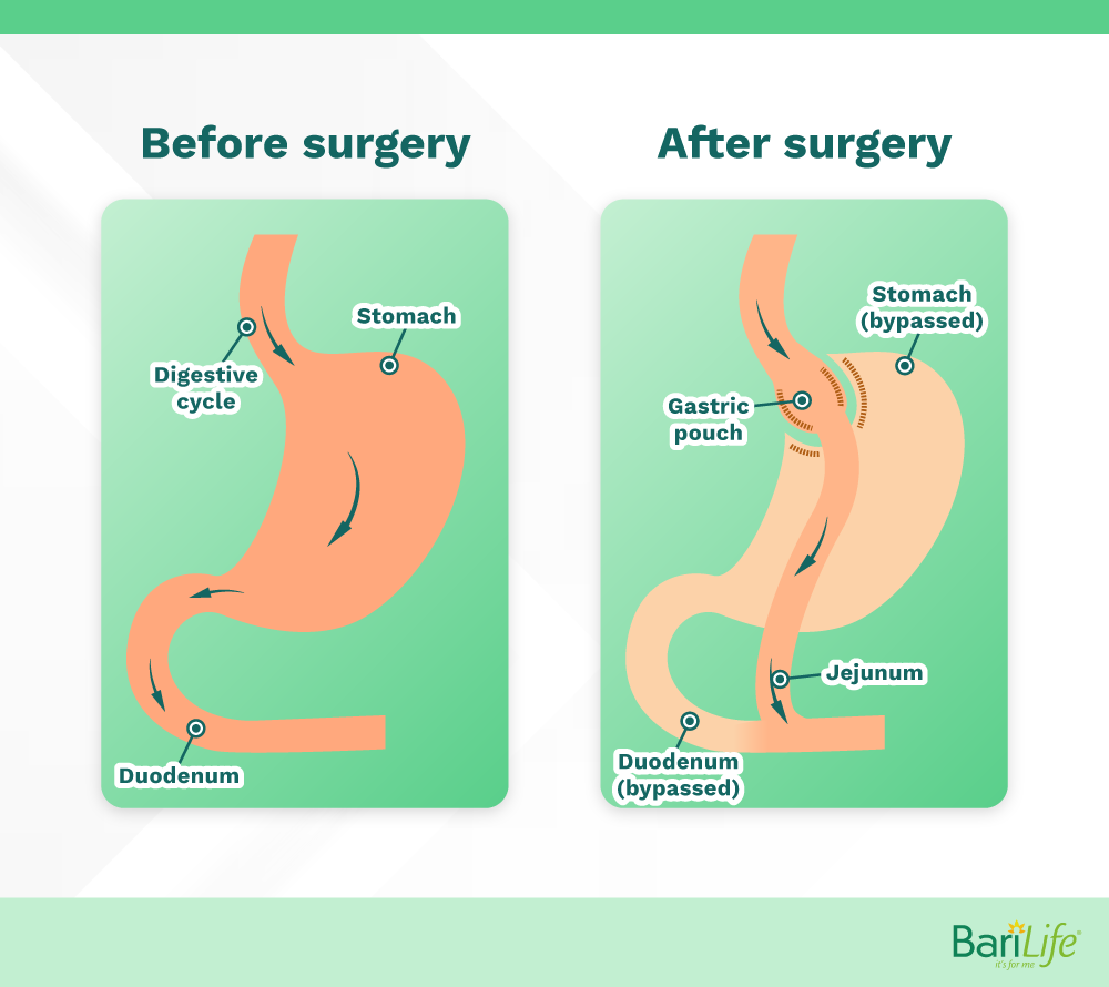 Gastric bypass surgery before and after