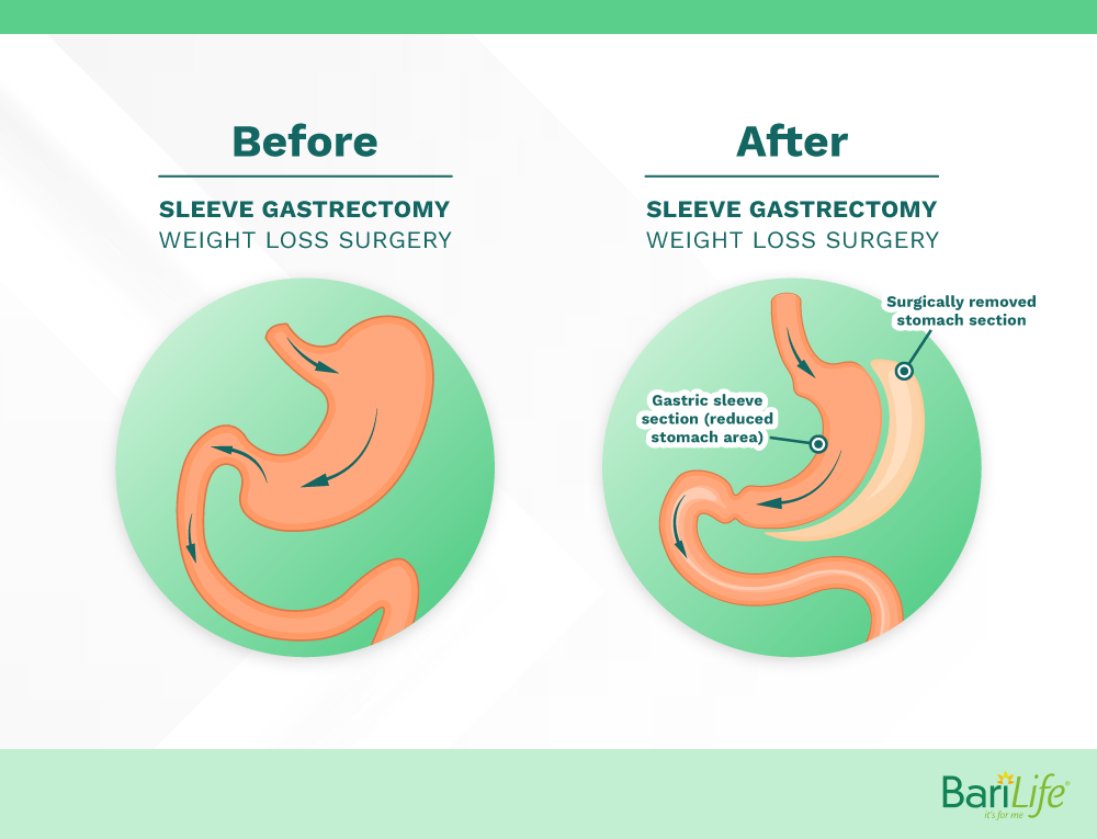 Sleeve gastrectomy before and after
