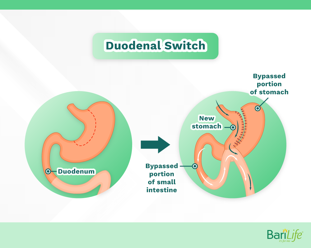 Duodenal Switch before and after