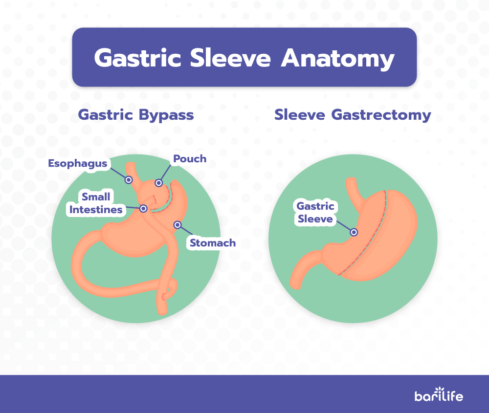 Gastric Sleeve Incisions - Everything you need to know Bari Life