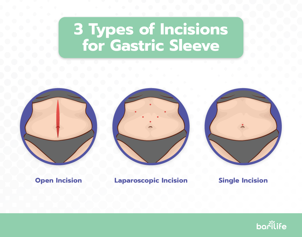 Gastric Sleeve Incision Types