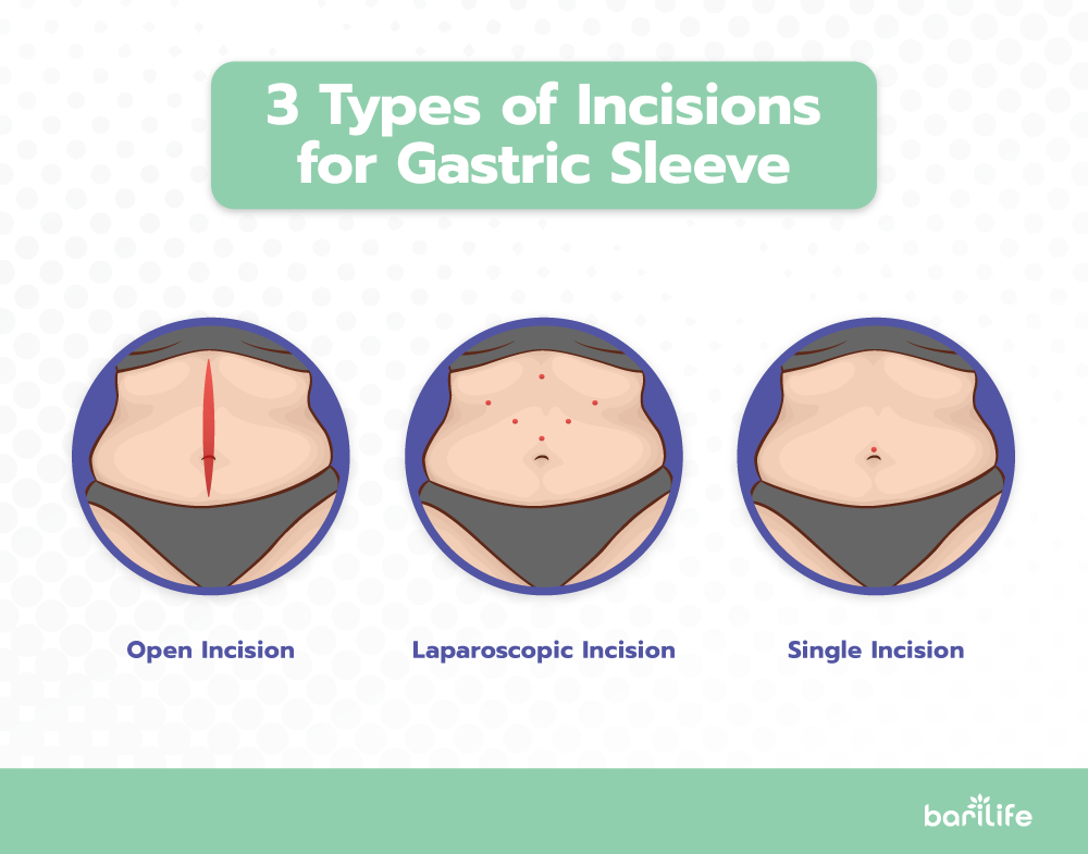 Gastric Sleeve Incisions - Everything you need to know Bari Life