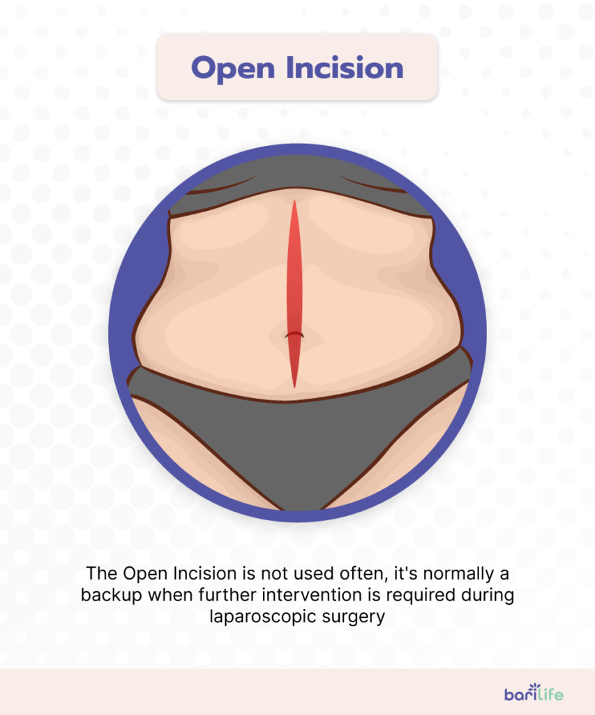 Gastric Sleeve Incisions - Everything you need to know Bari Life