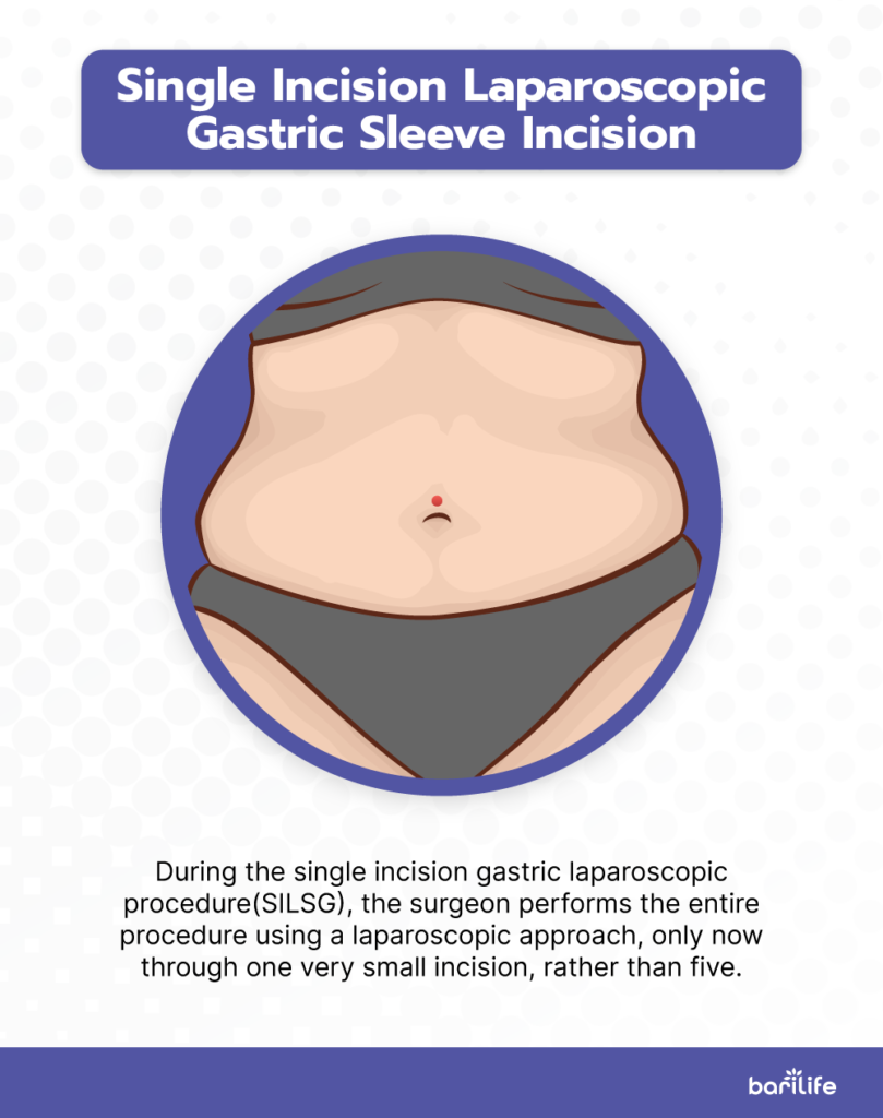 Single Incision Gastric Sleeve