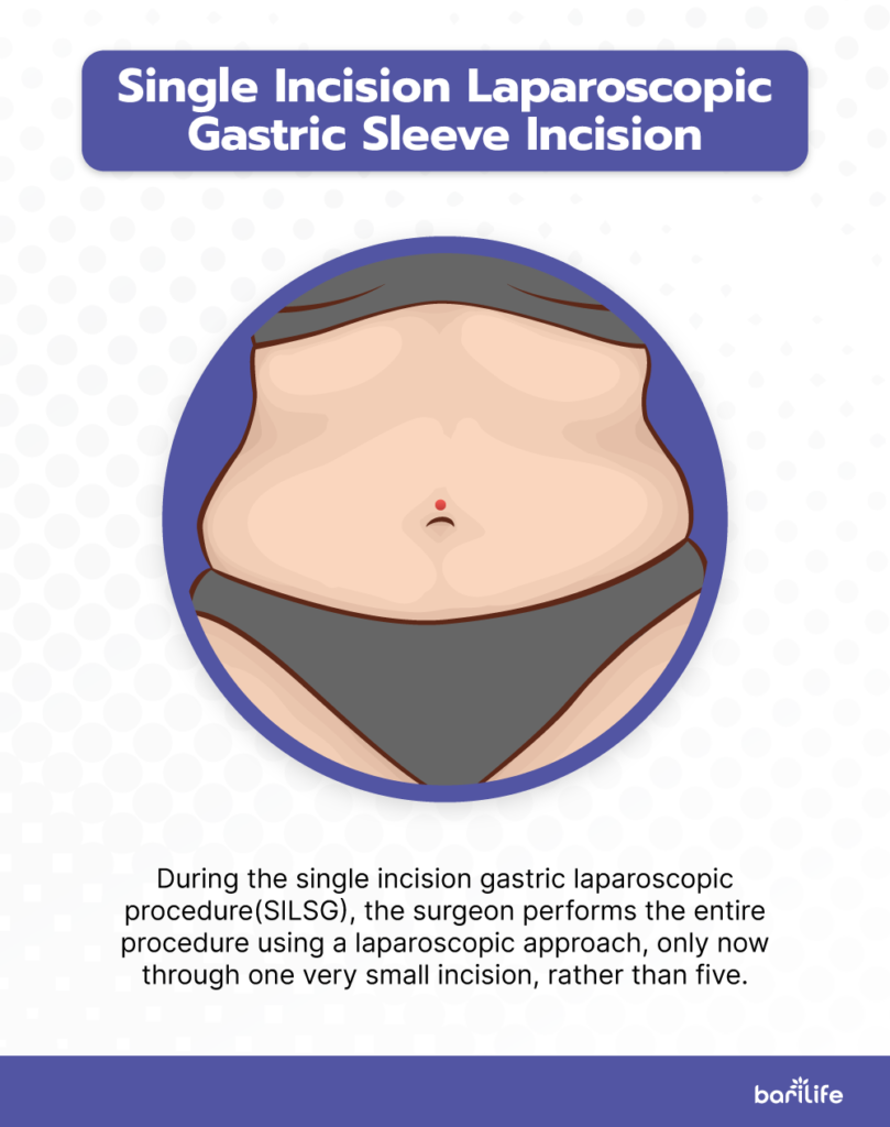 Gastric Sleeve Incisions - Everything you need to know Bari Life