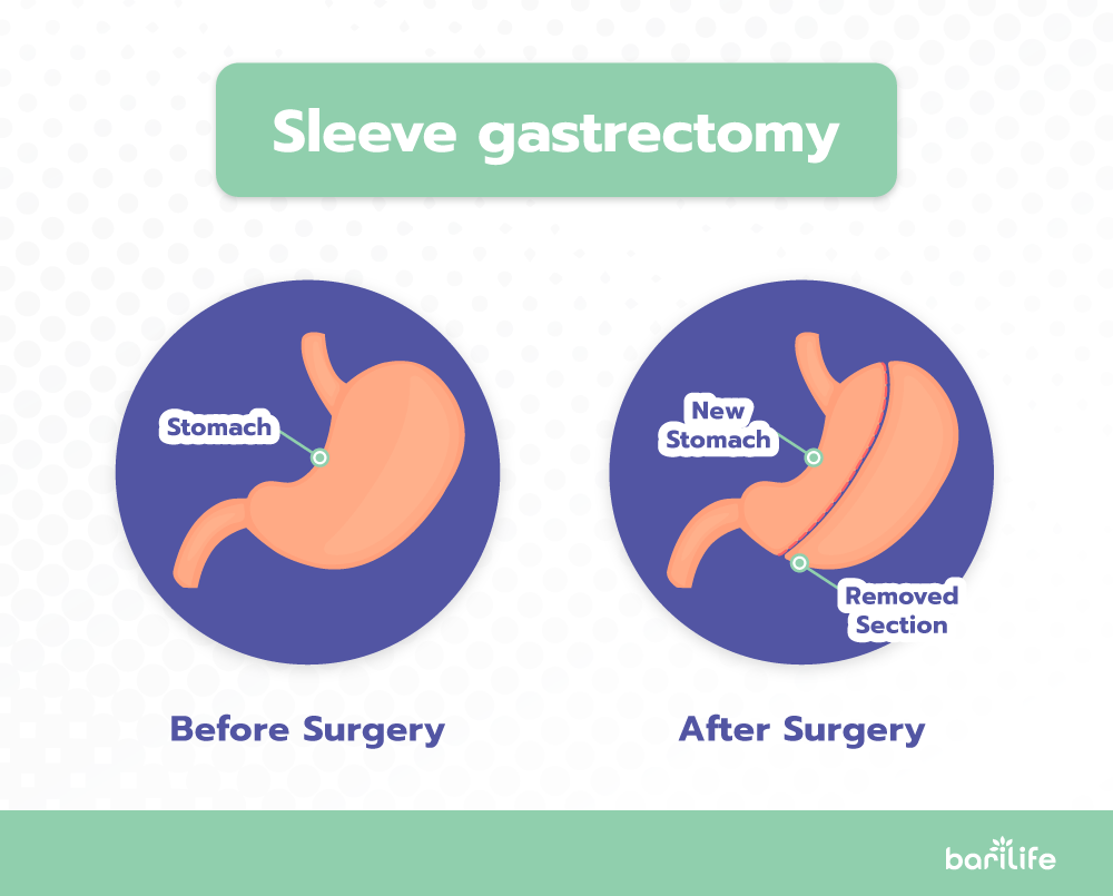 How to overcome your weight loss plateau after gastric sleeve surgery Bari Life