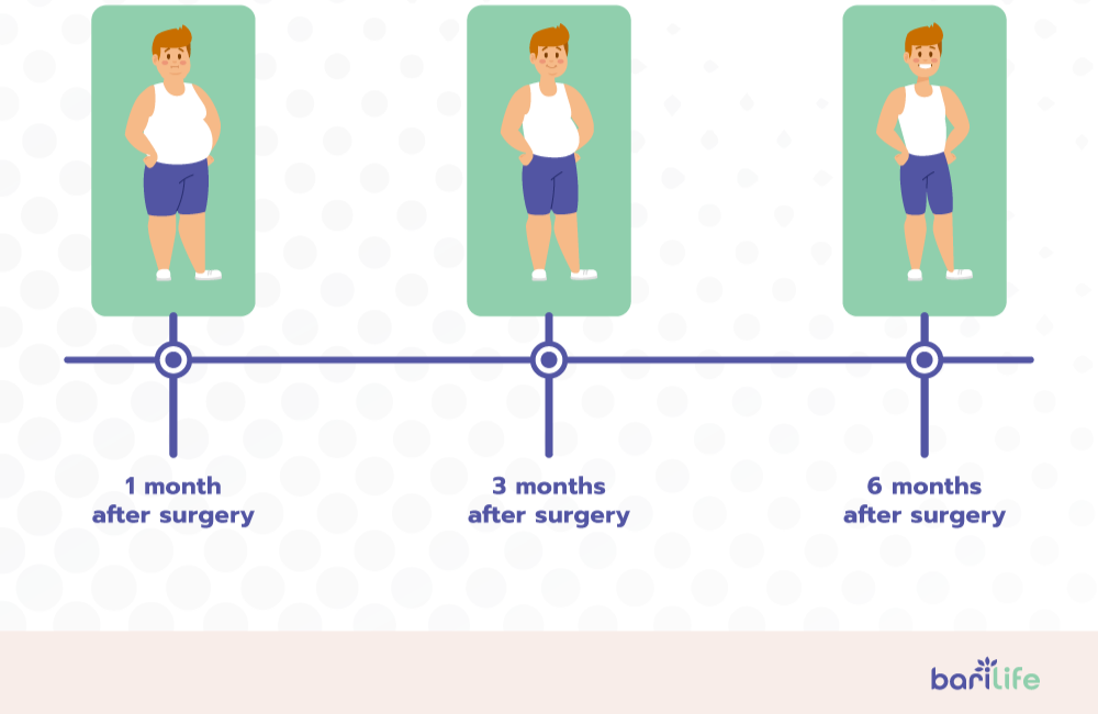 How to restart weight loss after gastric sleeve timeline