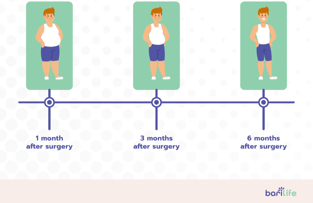 How to overcome your weight loss plateau after gastric sleeve surgery Bari Life