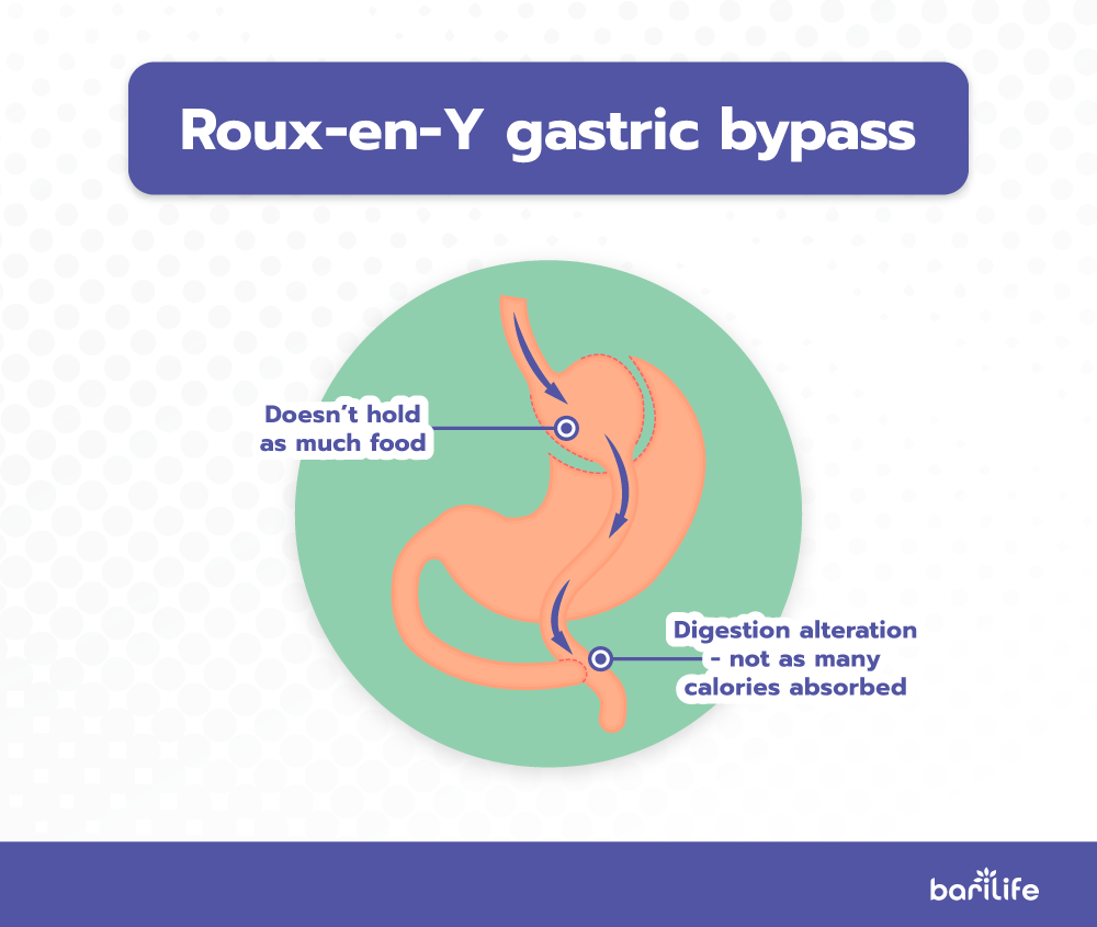 RNY Gastric Bypass