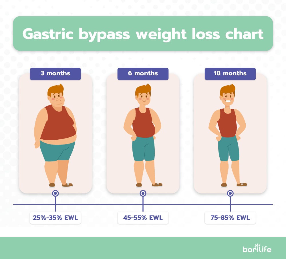 Gastric Bypass Weight Loss Chart Timeline