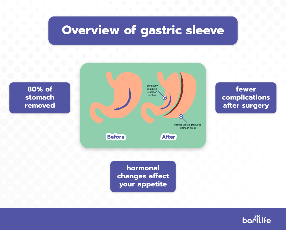 Exactly how long is a laparoscopic gastric sleeve surgery? Bari Life