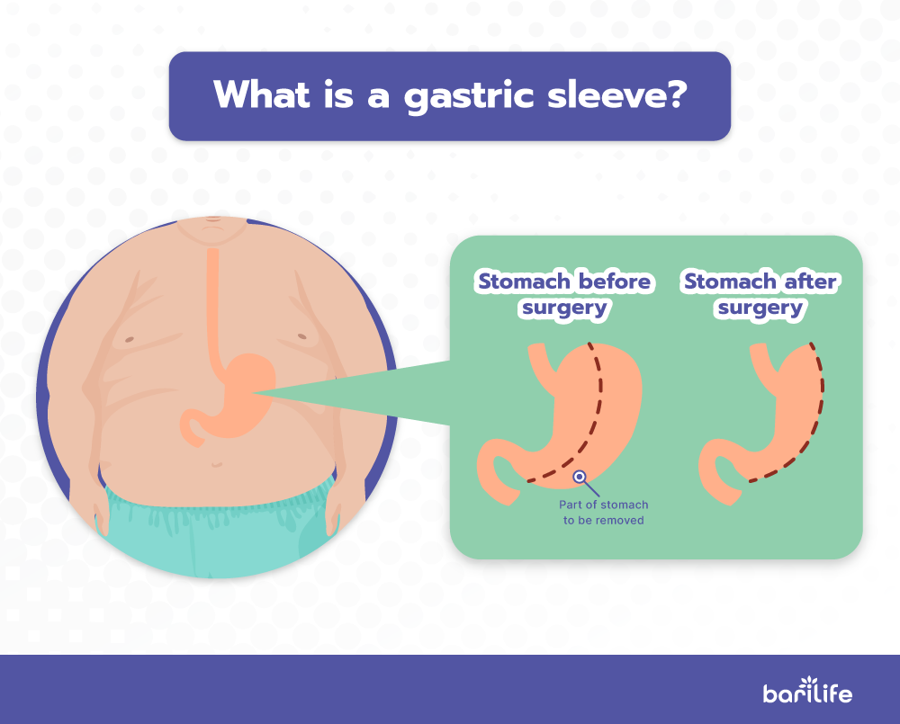 Gastric Bypass After Gastric Sleeve Bari Life