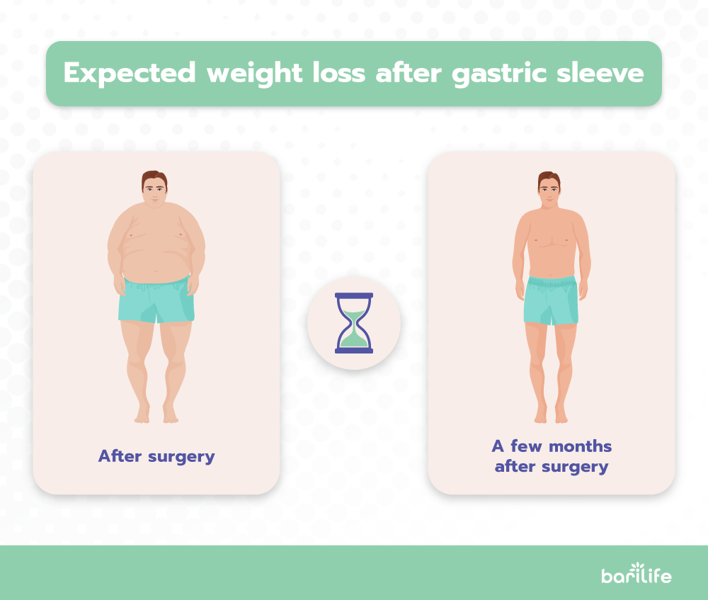 Gastric Bypass After Gastric Sleeve Bari Life